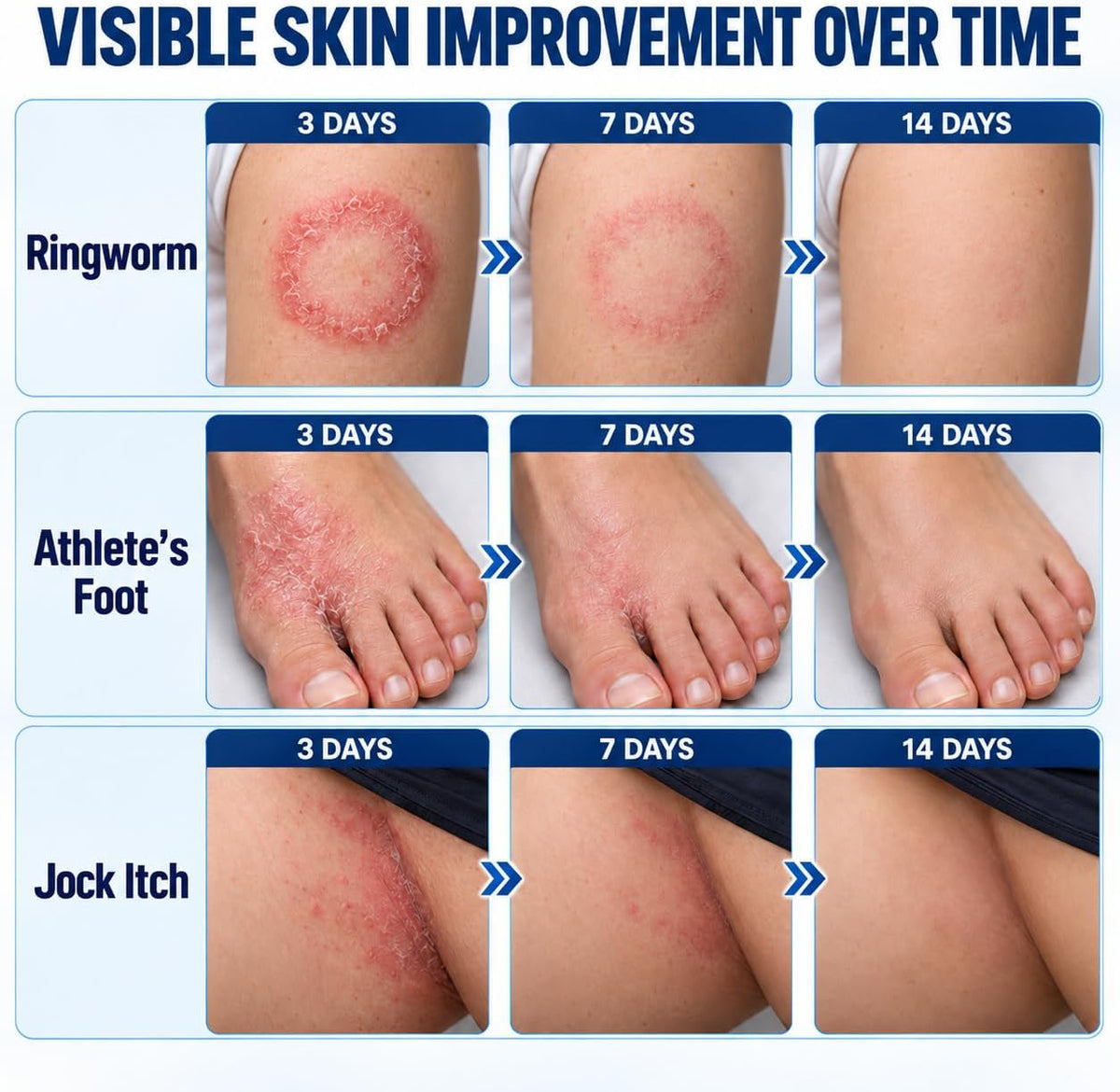 Antifungal Ringworm Treatment Cream: Miconazole Nitrate 2%