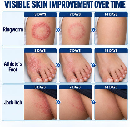 Antifungal Ringworm Treatment Cream: Miconazole Nitrate 2%